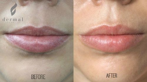 Lip-Injection-Before-After